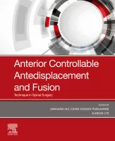 Anterior Controllable Antedisplacement and Fusion